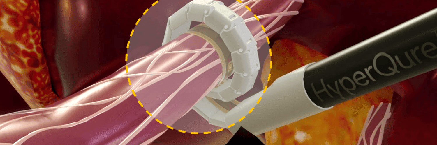 Renal Denervation Technology - Seeking Experts (Global) image