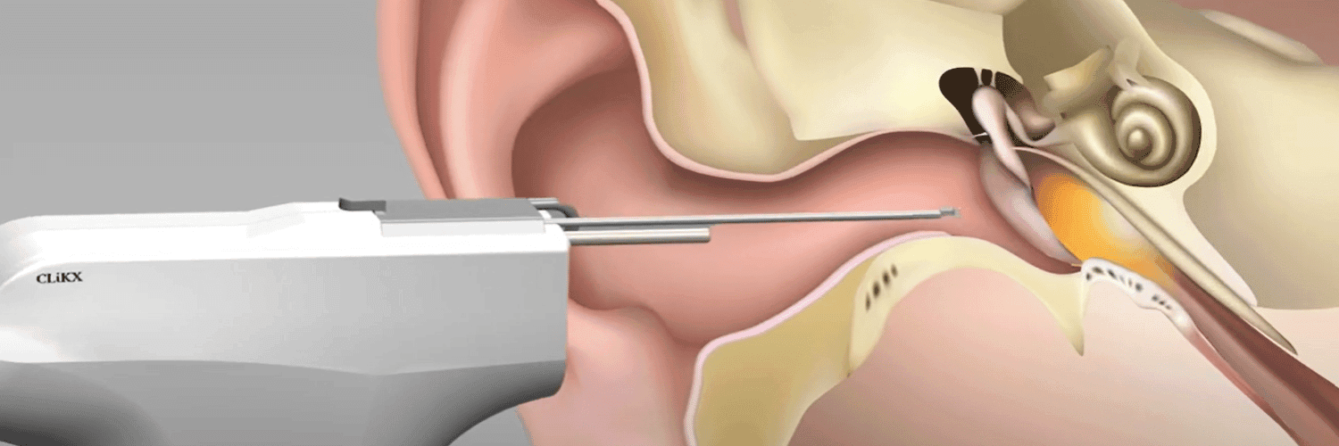 Handheld Robotic Ventilation Tube Applicator For Glue Ear Surgery - Seeking Experts in India image