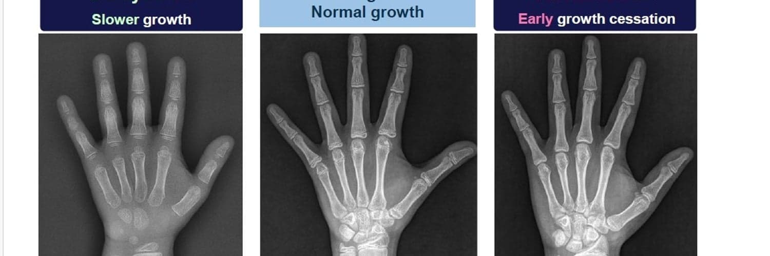 AI Driven Bone Age Analysis -Seeking Advisors in USA image